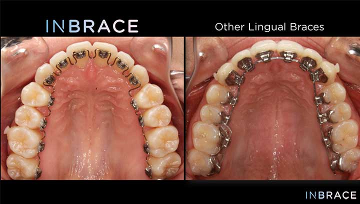 What to Know About Lingual Braces - Gibbs Orthodontics